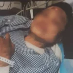 Kondisi TKW asal Jampangtengah Kabupaten Sukabumi yang disiram air panas oleh majikannya di Arab Saudi. (Sumber : Istimewa)