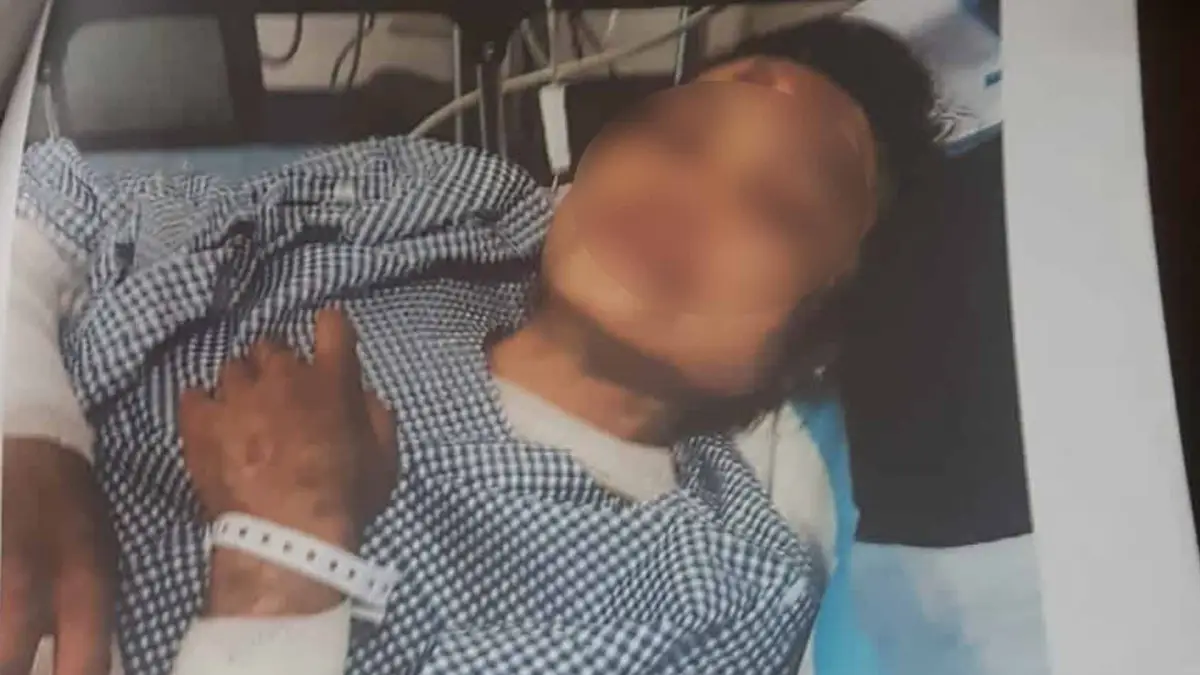 Kondisi TKW asal Jampangtengah Kabupaten Sukabumi yang disiram air panas oleh majikannya di Arab Saudi. (Sumber : Istimewa)